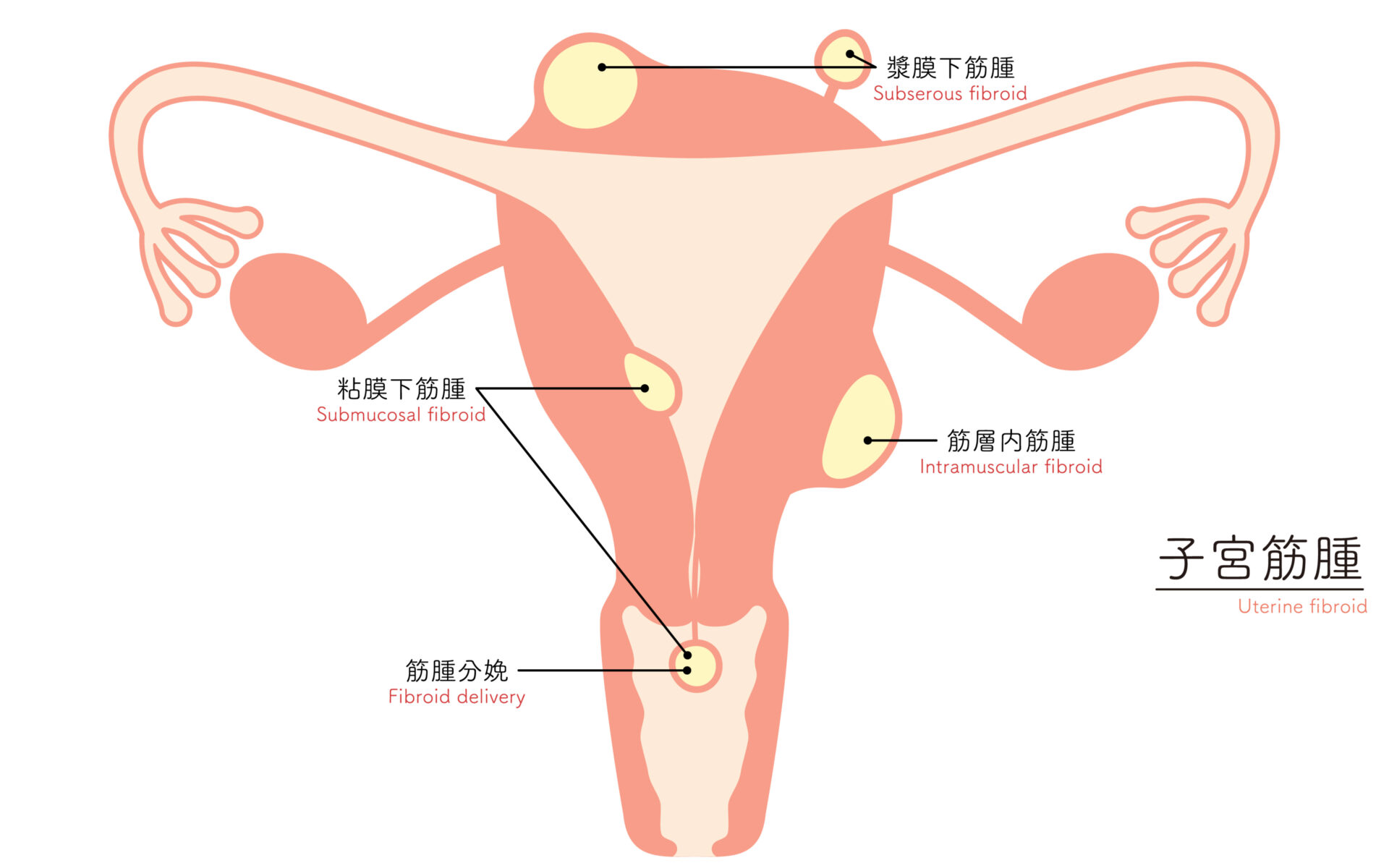 【イラスト】子宮筋腫の図解イラスト