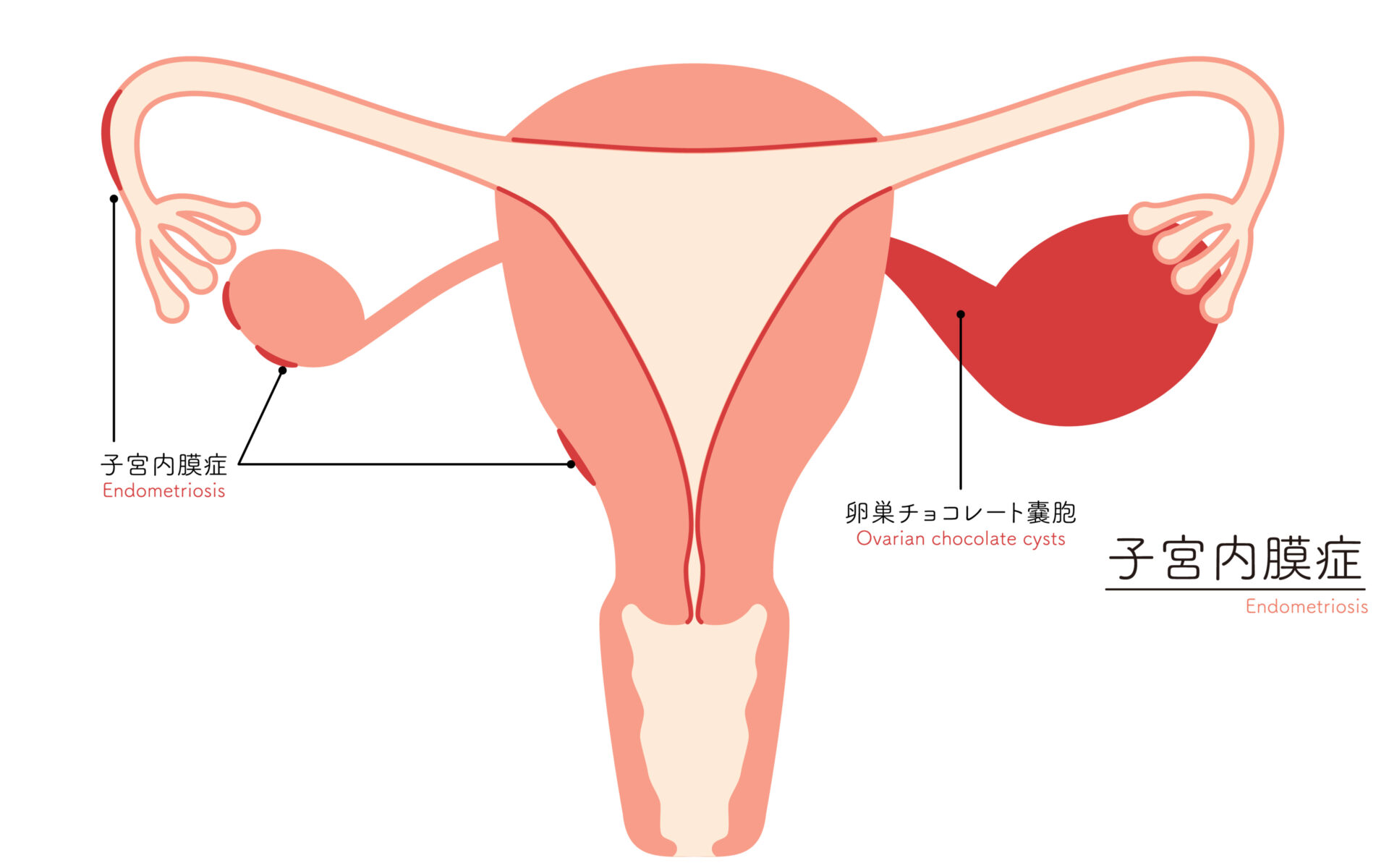 【イラスト】子宮内膜症の図解イラスト